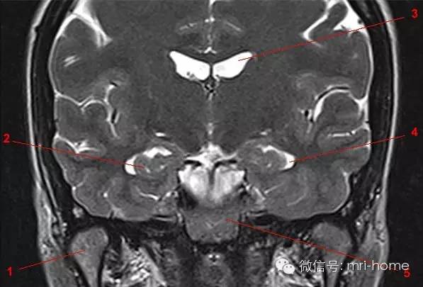 鞍区、垂体磁共振（MRI）解剖——冠状面