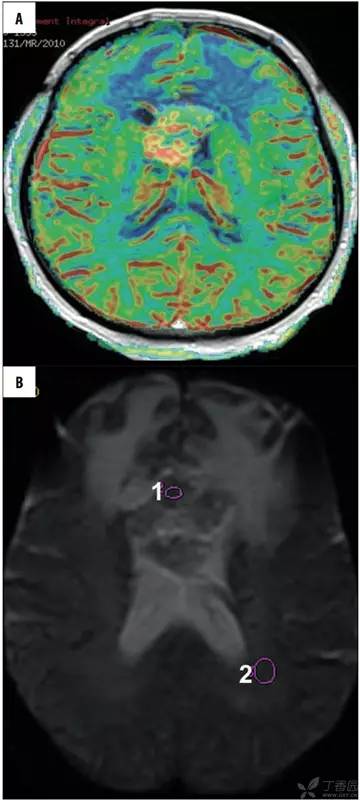 头颅 MRI：T2 相低信号病变汇总