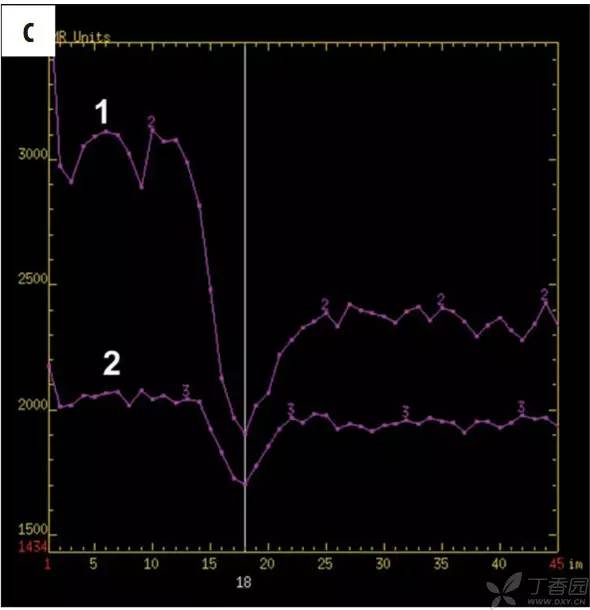 头颅 MRI:T2 相低信号病变汇总 头颅 MRI:T2 相低信号病变汇总