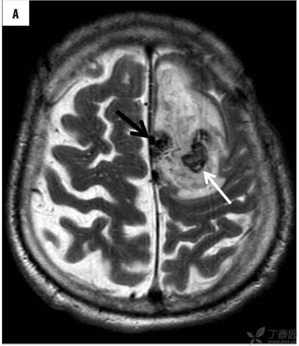 头颅 MRI:T2 相低信号病变汇总 头颅 MRI:T2 相低信号病变汇总