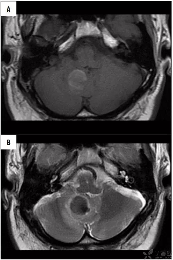 头颅 MRI:T2 相低信号病变汇总 头颅 MRI:T2 相低信号病变汇总