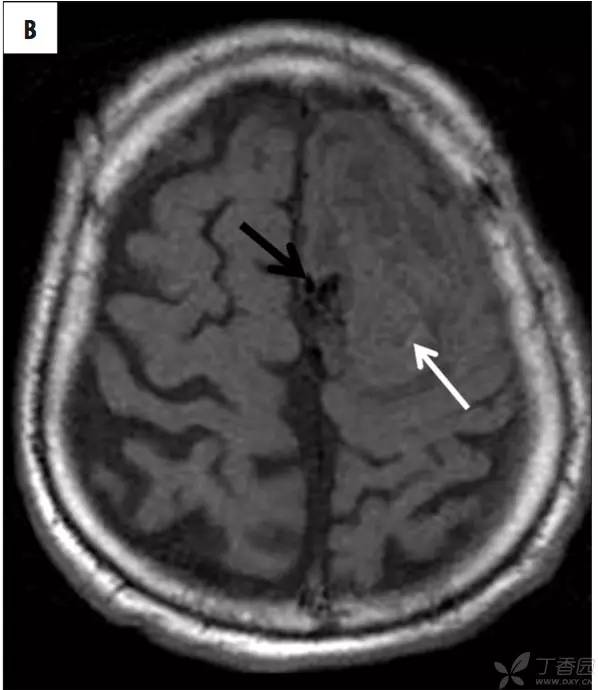 头颅 MRI:T2 相低信号病变汇总 头颅 MRI:T2 相低信号病变汇总