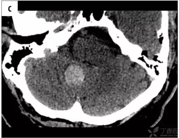 头颅 MRI:T2 相低信号病变汇总 头颅 MRI:T2 相低信号病变汇总