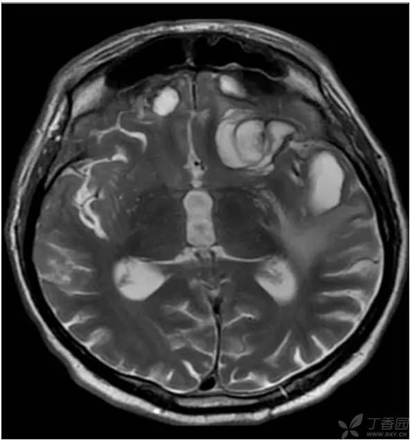 头颅 MRI:T2 相低信号病变汇总 头颅 MRI:T2 相低信号病变汇总