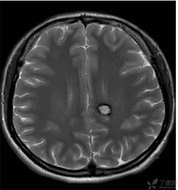 头颅 MRI:T2 相低信号病变汇总 头颅 MRI:T2 相低信号病变汇总