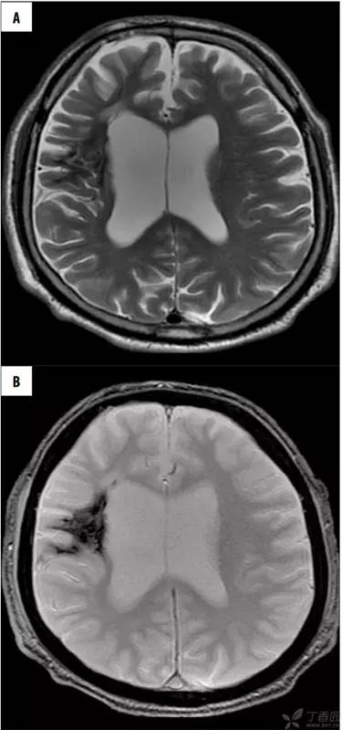 头颅 MRI:T2 相低信号病变汇总 头颅 MRI:T2 相低信号病变汇总