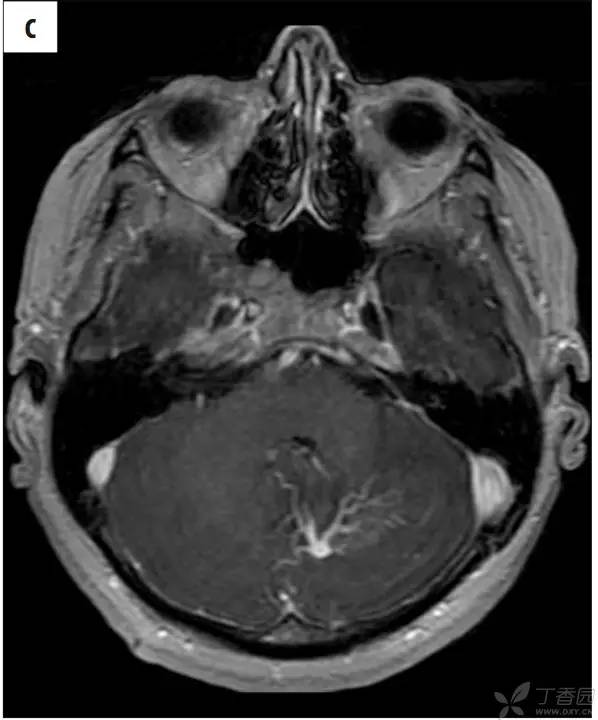 头颅 MRI:T2 相低信号病变汇总 头颅 MRI:T2 相低信号病变汇总