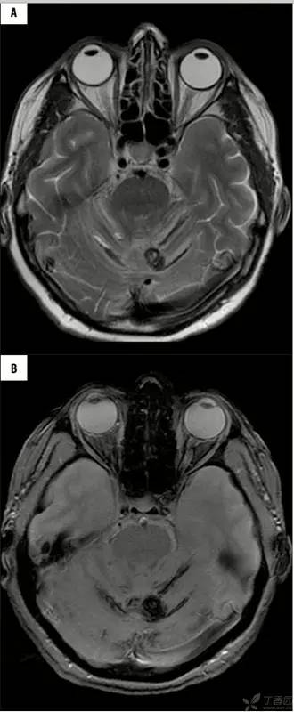 头颅 MRI:T2 相低信号病变汇总 头颅 MRI:T2 相低信号病变汇总