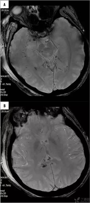 头颅 MRI:T2 相低信号病变汇总 头颅 MRI:T2 相低信号病变汇总