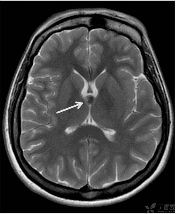 头颅 MRI:T2 相低信号病变汇总 头颅 MRI:T2 相低信号病变汇总