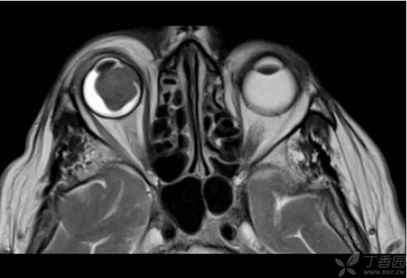 头颅 MRI:T2 相低信号病变汇总 头颅 MRI:T2 相低信号病变汇总
