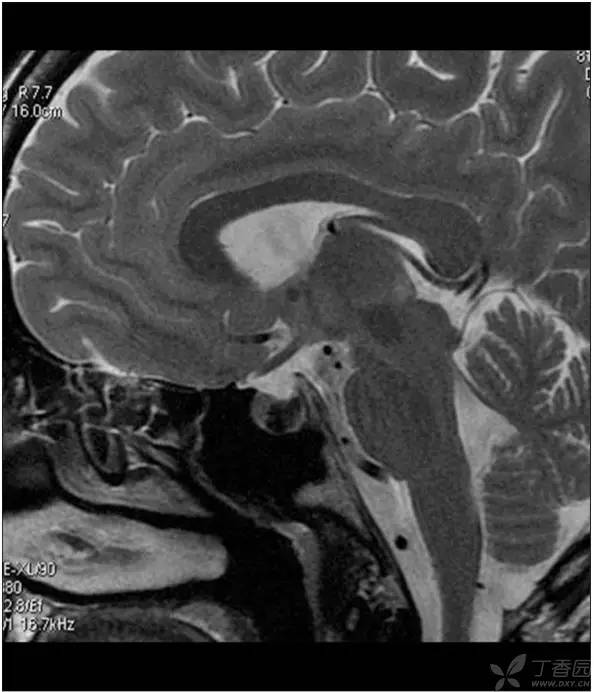 头颅 MRI:T2 相低信号病变汇总 头颅 MRI:T2 相低信号病变汇总