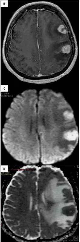 头颅 MRI:T2 相低信号病变汇总 头颅 MRI:T2 相低信号病变汇总