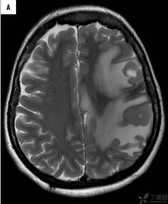 头颅 MRI:T2 相低信号病变汇总 头颅 MRI:T2 相低信号病变汇总