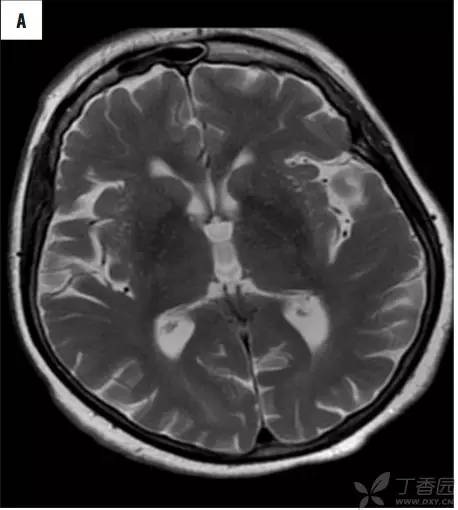 头颅 MRI:T2 相低信号病变汇总 头颅 MRI:T2 相低信号病变汇总