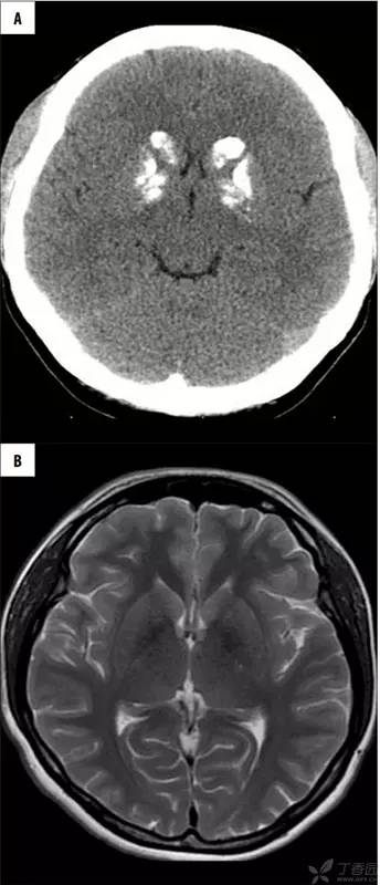 头颅 MRI:T2 相低信号病变汇总 头颅 MRI:T2 相低信号病变汇总