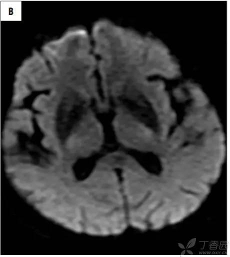 头颅 MRI:T2 相低信号病变汇总 头颅 MRI:T2 相低信号病变汇总