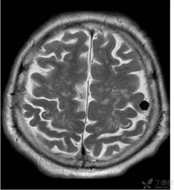 头颅 MRI:T2 相低信号病变汇总 头颅 MRI:T2 相低信号病变汇总