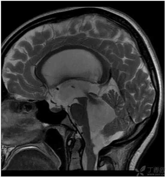 头颅 MRI:T2 相低信号病变汇总 头颅 MRI:T2 相低信号病变汇总