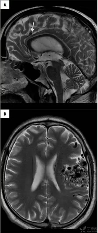 头颅 MRI:T2 相低信号病变汇总 头颅 MRI:T2 相低信号病变汇总