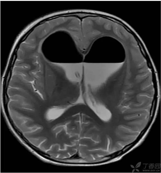 头颅 MRI:T2 相低信号病变汇总 头颅 MRI:T2 相低信号病变汇总