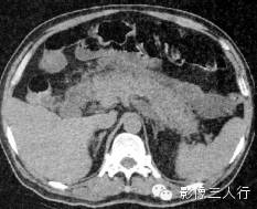 急性胰腺炎的CT报告书写技巧与提示 急性胰腺炎的CT报告书写技巧与提示