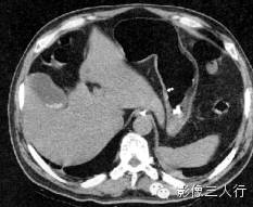 急性胰腺炎的CT报告书写技巧与提示