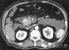 急性胰腺炎的CT报告书写技巧与提示 急性胰腺炎的CT报告书写技巧与提示