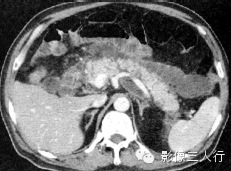 急性胰腺炎的CT报告书写技巧与提示 急性胰腺炎的CT报告书写技巧与提示
