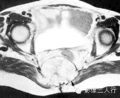 骶尾部常见疾病的鉴别诊断