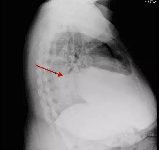 【病例】腹膜透析并发胸腹瘘一例