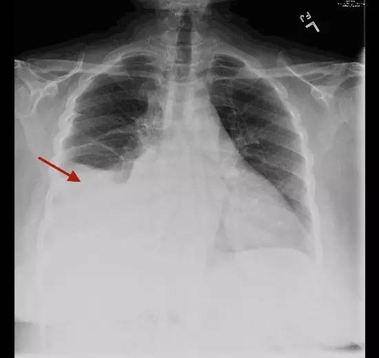 【病例】腹膜透析并发胸腹瘘一例