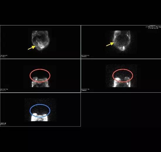 【病例】腹膜透析并发胸腹瘘一例