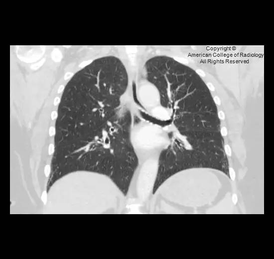 【病例】腹膜透析并发胸腹瘘一例