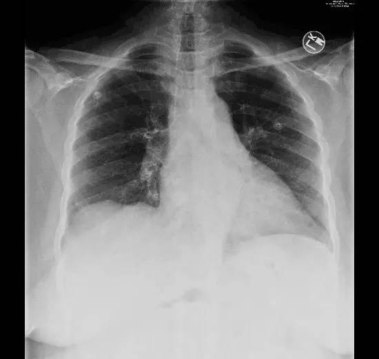 【病例】腹膜透析并发胸腹瘘一例