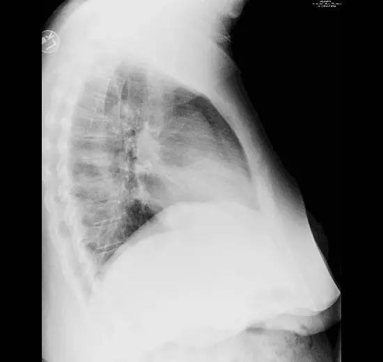 【病例】腹膜透析并发胸腹瘘一例