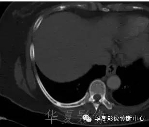 【病例】结节性硬化1例影像表现