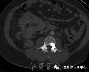 【病例】结节性硬化1例影像表现