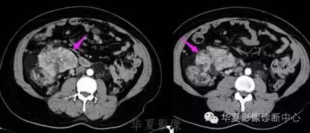 【病例】结节性硬化1例影像表现