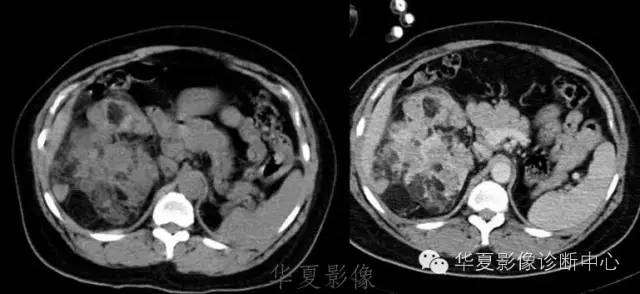 【病例】结节性硬化1例影像表现