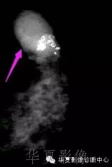 【病例】结节性硬化1例影像表现