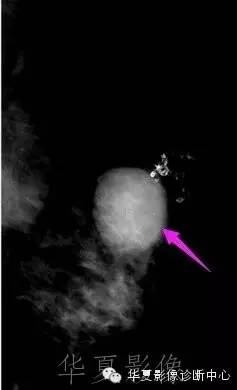 【病例】结节性硬化1例影像表现
