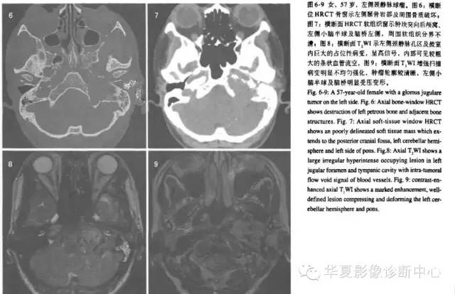 【病例】颈静脉球瘤1例