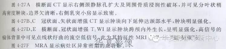 【病例】颈静脉球瘤1例