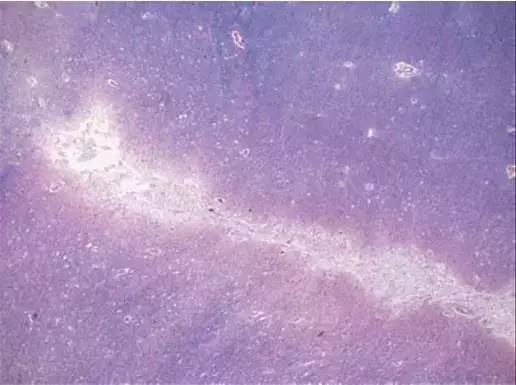 一图读懂被很多医生误诊、漏诊的脑小血管病