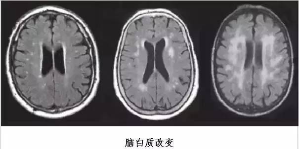 一图读懂被很多医生误诊、漏诊的脑小血管病
