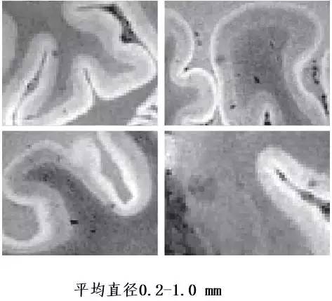 一图读懂被很多医生误诊、漏诊的脑小血管病