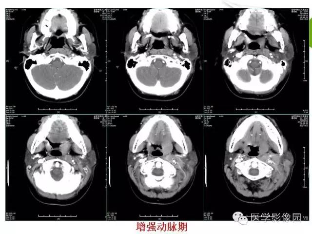 【病例】颈部淋巴瘤1例CT影像表现