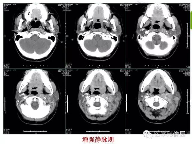 【病例】颈部淋巴瘤1例CT影像表现