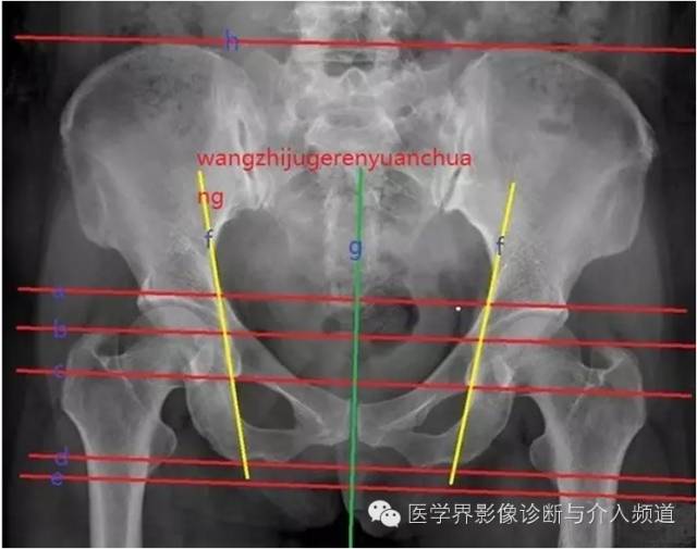 骨盆X片，这些径线你还记得吗？